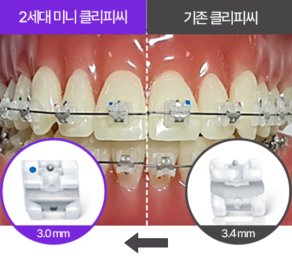 2.디지털치아교정_NEW_클리피씨2